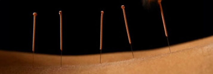 Chiropractic Bowie MD Dry Needling On Back